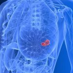 Indian American Researcher Amongst Scientists Identifying Potential Breast Cancer Drug breast cancer drug