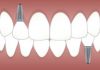 Reasons Why Replacing Lost Teeth is Important Replacing lost teeth