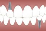 Reasons Why Replacing Lost Teeth is Important Replacing lost teeth