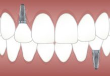 Reasons Why Replacing Lost Teeth is Important Replacing lost teeth