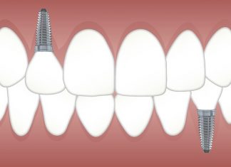 Reasons Why Replacing Lost Teeth is Important Replacing lost teeth