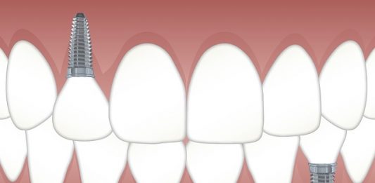 Replacing lost teeth