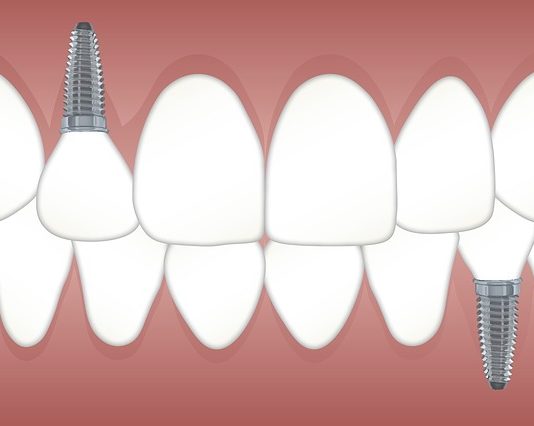 Reasons Why Replacing Lost Teeth is Important Replacing lost teeth