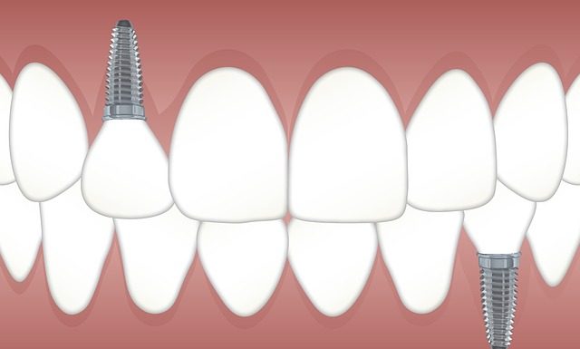 Reasons Why Replacing Lost Teeth is Important Replacing lost teeth