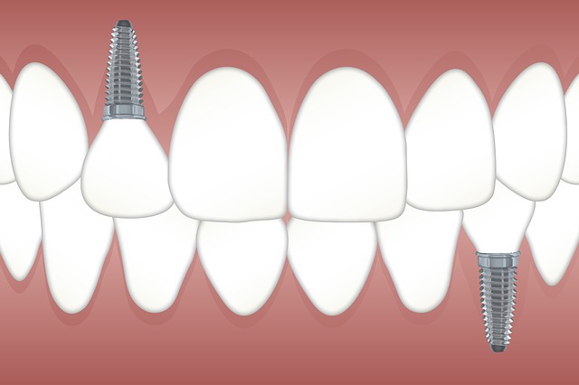 Replacing lost teeth