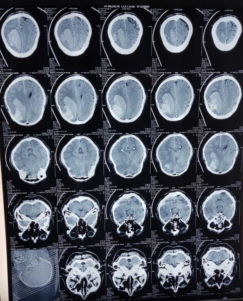 CT Scan of Armyman treated at AMU Aligarh, Medical College