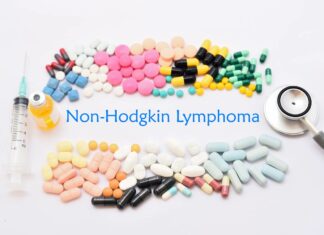 What You Need To Know About Non-Hodgkin’s Lymphoma Non-Hodgkin-Lymphoma
